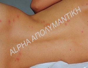 Επιπτώσεις από τους κοριούς